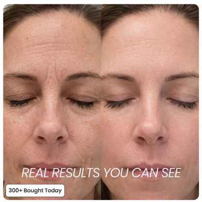 Erase Wrinkles & Fine Lines - Reclaim Your Youthful, Radiant Skin Naturally